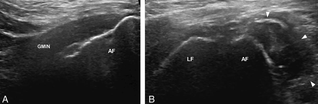 Gluteo menor 2 ecografia tempo formacion.jpg
